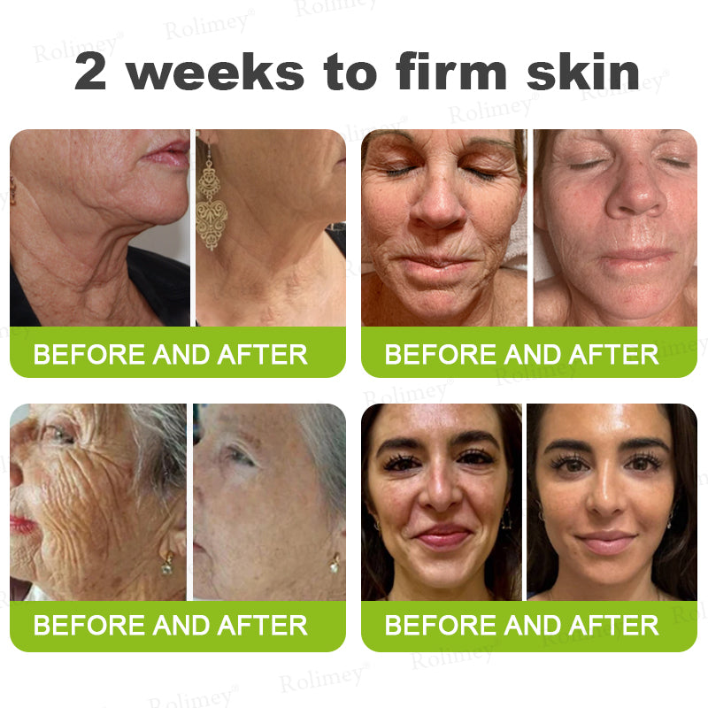 🧑‍⚕️ Rolimey® Botox-Like Peptides + Vita-A Retinol Shot – Wrinkle-Lift Tightening Cream - Last Day Promotion 50% OFF