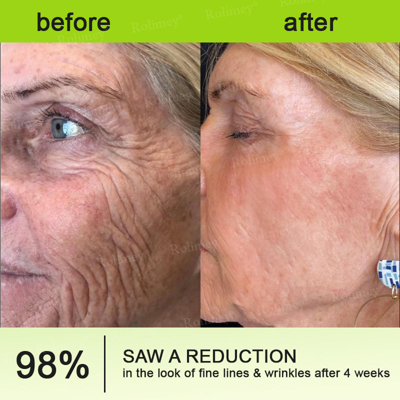 🧑‍⚕️ Rolimey® Botox-Like Peptides + Vita-A Retinol Shot – Wrinkle-Lift Tightening Cream - Last Day Promotion 50% OFF