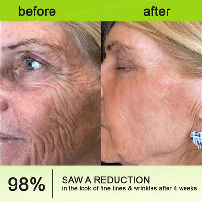 🧑‍⚕️ Rolimey® Botox-Like Peptides + Vita-A Retinol Shot – Wrinkle-Lift Tightening Cream - Last Day Promotion 50% OFF