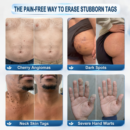 👩‍⚕️ 𝐎𝐟𝐟𝐢𝐜𝐢𝐚𝐥 𝐒𝐭𝐨𝐫𝐞 | GFOUK® 🌿 𝐁𝐨𝐭𝐚𝐧𝐢𝐜𝐚𝐥 𝐌𝐢𝐜𝐫𝐨𝐧𝐞𝐞𝐝𝐥𝐞 𝐇𝐲𝐝𝐫𝐨𝐜𝐨𝐥𝐥𝐨𝐢𝐝 𝐏𝐚𝐭𝐜𝐡 (𝐅𝐨𝐫 𝐒𝐤𝐢𝐧 𝐓𝐚𝐠𝐬, 𝐒𝐦𝐚𝐥𝐥 𝐒𝐤𝐢𝐧 𝐆𝐫𝐨𝐰𝐭𝐡𝐬, 𝐖𝐚𝐫𝐭𝐬, 𝐌𝐨𝐥𝐞𝐬, 𝐀𝐠𝐞 𝐒𝐩𝐨𝐭𝐬 & 𝐏𝐢𝐠𝐦𝐞𝐧𝐭𝐚𝐭𝐢𝐨𝐧 𝐂𝐨𝐧𝐜𝐞𝐫𝐧𝐬)