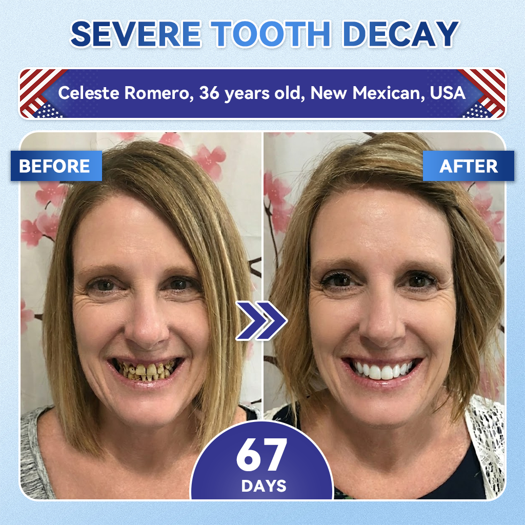 Smile instantly 🦷 GFOUK®⭐⭐ 𝑇𝑖𝑑𝑒𝑔𝑙𝑢𝑠𝑖𝑏 𝑇𝑜𝑜𝑡ℎ & 𝐺𝑢𝑚 𝑅𝑒𝑝𝑎𝑖𝑟 𝐹𝑎𝑠𝑡-𝐷𝑖𝑠𝑠𝑜𝑙𝑣𝑖𝑛𝑔 𝑊ℎ𝑖𝑡𝑒𝑛𝑖𝑛𝑔 𝑆𝑡𝑟𝑖𝑝𝑠  (𝟓-𝐢𝐧-𝟏 💎 𝐑𝐞𝐛𝐮𝐢𝐥𝐝 𝐄𝐧𝐚𝐦𝐞𝐥 & 𝐃𝐞𝐧𝐭𝐢𝐧 • 𝐒𝐭𝐫𝐞𝐧𝐠𝐭𝐡𝐞𝐧 𝐆𝐮𝐦𝐬 • 𝐄𝐫𝐚𝐝𝐢𝐜𝐚𝐭𝐞 𝐓𝐚𝐫𝐭𝐚𝐫 & 𝐎𝐝𝐨𝐫 • 𝐖𝐡𝐢𝐭𝐞𝐧𝐢𝐧𝐠 • 𝐒𝐭𝐨𝐩 𝐓𝐨𝐨𝐭𝐡 𝐒𝐞𝐧𝐬𝐢𝐭𝐢𝐯𝐢𝐭𝐲)