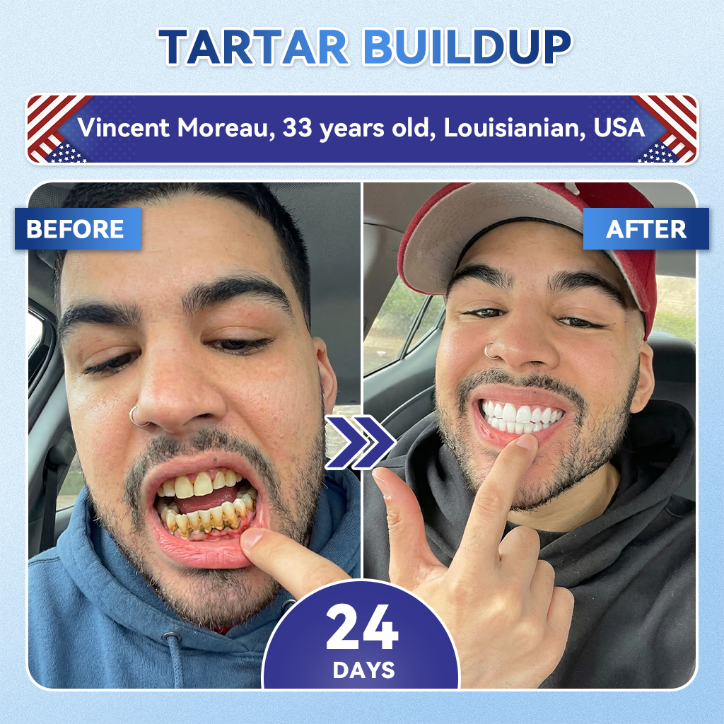 Smile instantly 🦷 GFOUK®⭐⭐ 𝑇𝑖𝑑𝑒𝑔𝑙𝑢𝑠𝑖𝑏 𝑇𝑜𝑜𝑡ℎ & 𝐺𝑢𝑚 𝑅𝑒𝑝𝑎𝑖𝑟 𝐹𝑎𝑠𝑡-𝐷𝑖𝑠𝑠𝑜𝑙𝑣𝑖𝑛𝑔 𝑊ℎ𝑖𝑡𝑒𝑛𝑖𝑛𝑔 𝑆𝑡𝑟𝑖𝑝𝑠  (𝟓-𝐢𝐧-𝟏 💎 𝐑𝐞𝐛𝐮𝐢𝐥𝐝 𝐄𝐧𝐚𝐦𝐞𝐥 & 𝐃𝐞𝐧𝐭𝐢𝐧 • 𝐒𝐭𝐫𝐞𝐧𝐠𝐭𝐡𝐞𝐧 𝐆𝐮𝐦𝐬 • 𝐄𝐫𝐚𝐝𝐢𝐜𝐚𝐭𝐞 𝐓𝐚𝐫𝐭𝐚𝐫 & 𝐎𝐝𝐨𝐫 • 𝐖𝐡𝐢𝐭𝐞𝐧𝐢𝐧𝐠 • 𝐒𝐭𝐨𝐩 𝐓𝐨𝐨𝐭𝐡 𝐒𝐞𝐧𝐬𝐢𝐭𝐢𝐯𝐢𝐭𝐲)
