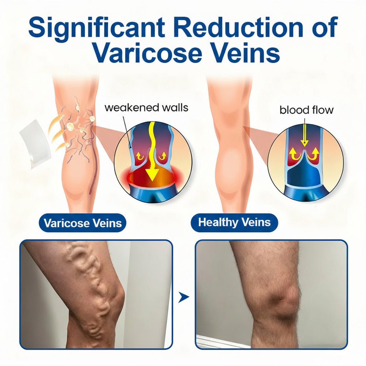 𝑶𝒇𝒇𝒊𝒄𝒊𝒂𝒍 𝑺𝒕𝒐𝒓𝒆🇺🇸  | ✅GFOUK®- VeinEase Microneedle Care Patch⚡Instant Relief, Long-Term Results