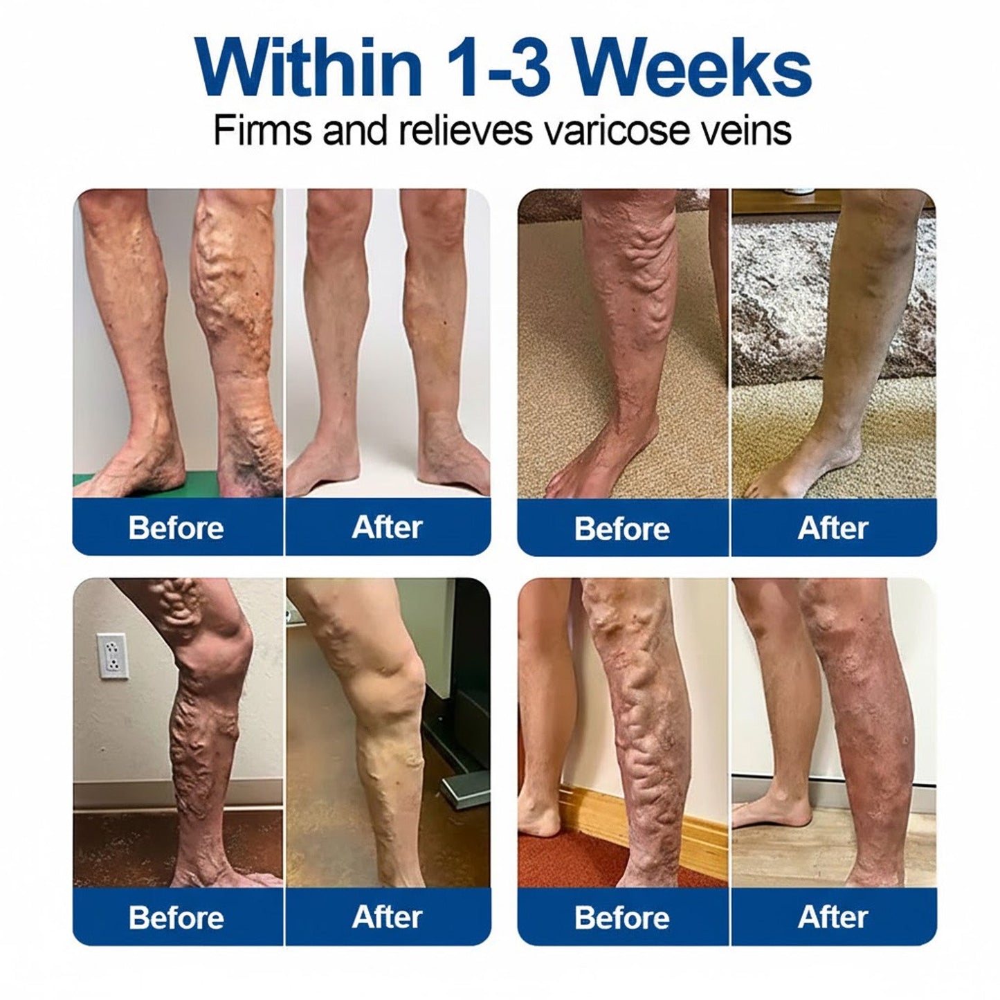 𝑶𝒇𝒇𝒊𝒄𝒊𝒂𝒍 𝑺𝒕𝒐𝒓𝒆🇺🇸  | ✅GFOUK®- VeinEase Microneedle Care Patch⚡Instant Relief, Long-Term Results