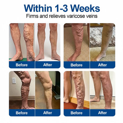 𝑶𝒇𝒇𝒊𝒄𝒊𝒂𝒍 𝑺𝒕𝒐𝒓𝒆🇺🇸  | ✅GFOUK®- VeinEase Microneedle Care Patch⚡Instant Relief, Long-Term Results