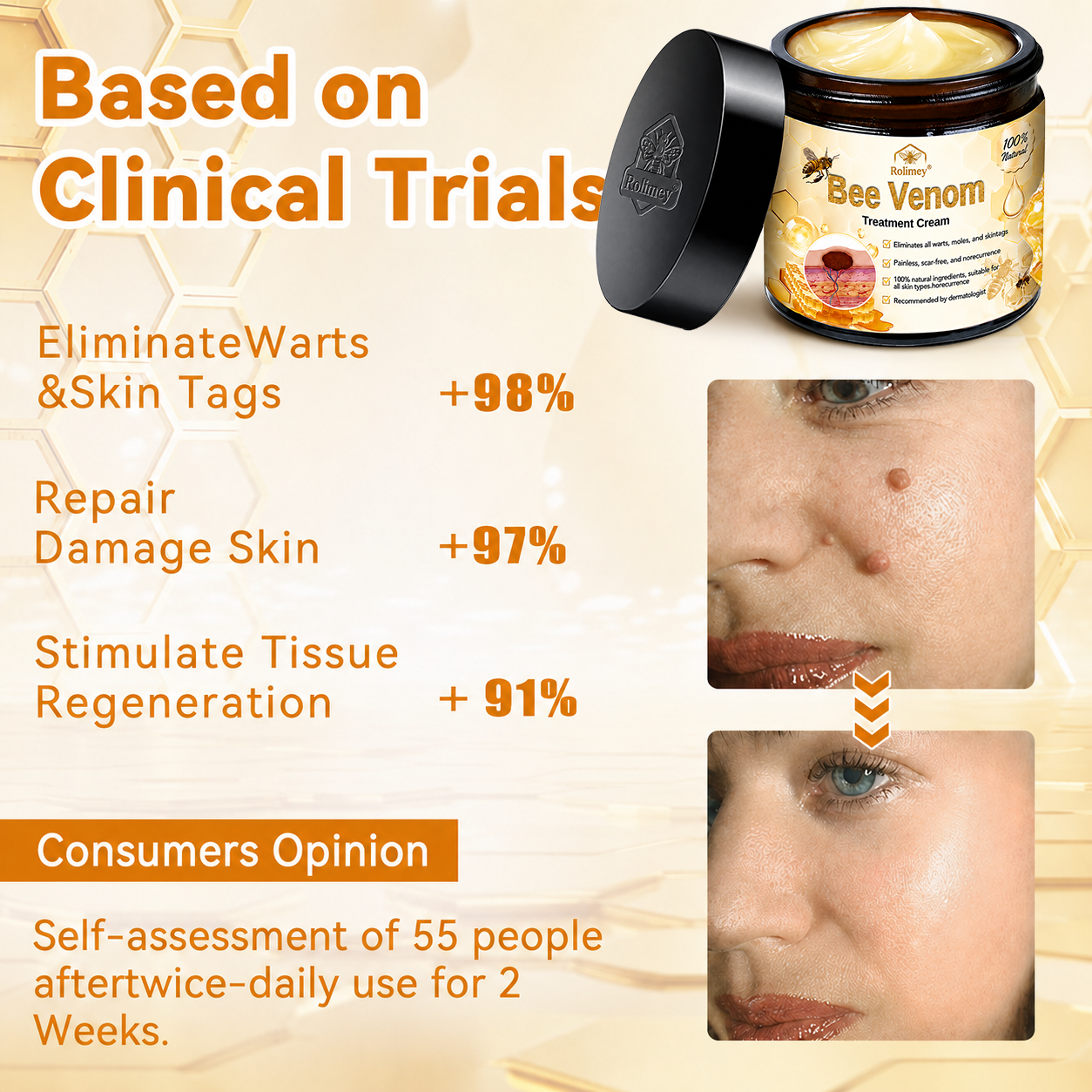 🥇👨‍⚕️Rolimey® Bee Venom Skin Treatment Cream - (Helping with acne, wart, rosacea, psoriasis, age spots, eczema, and reducing the appearance of stretch marks)