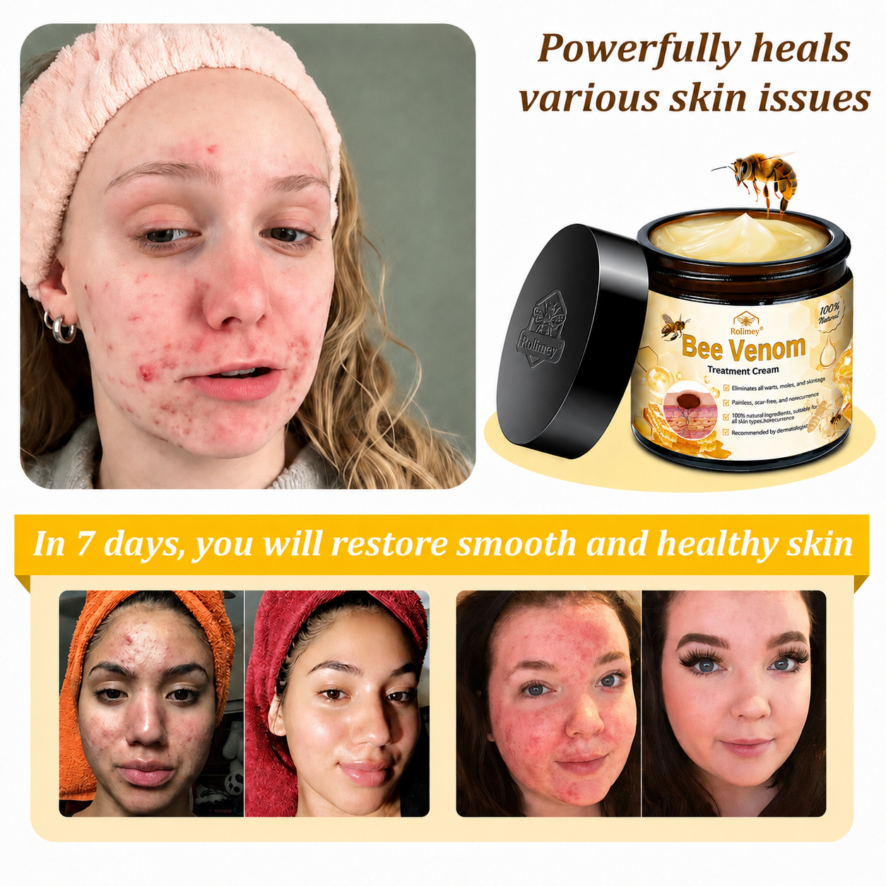 🥇👨‍⚕️Rolimey® Bee Venom Skin Treatment Cream - (Helping with acne, wart, rosacea, psoriasis, age spots, eczema, and reducing the appearance of stretch marks)