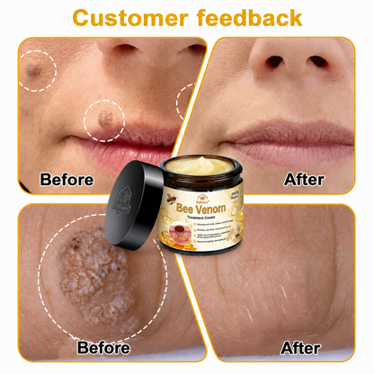 🥇👨‍⚕️Rolimey® Bee Venom Skin Treatment Cream - (Helping with acne, wart, rosacea, psoriasis, age spots, eczema, and reducing the appearance of stretch marks)